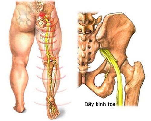 Vật lý trị liệu đau thần kinh tọa – niềm hy vọng nhiều bệnh nhân