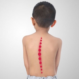 Cong vẹo cột sống trẻ em