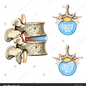 ĐIỀU TRỊ THOÁT VỊ ĐỊA ĐỆM