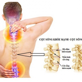 Thoái hoá cột sống