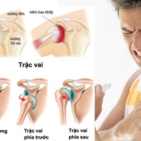 Điều trị viêm khớp Vai